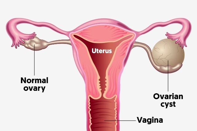 Ovarian-cyst-treatment-onions