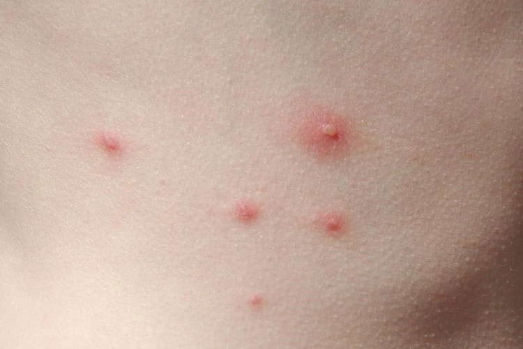 Pearly-papules-women