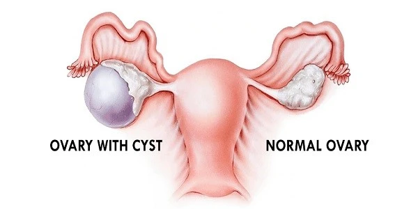Ovarian-cyst-complications