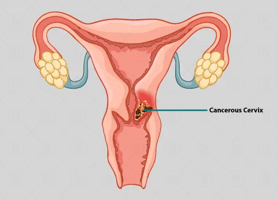 Precancerous-lesions-cervix