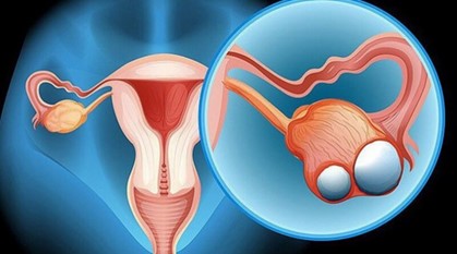 ایا کیست تخمدان باعث لاغری میشود