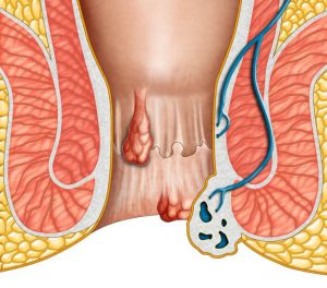 برای زخم دهانه رحم چه دارویی استفاده کنم