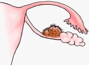 درمان دارویی کیست درموئید تخمدان