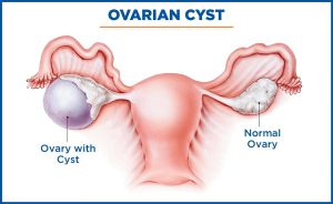 درمان کیست تخمدان چپ