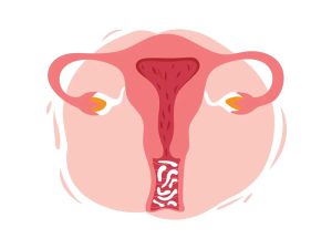 آیا عفونت قارچی واژن باعث نازایی میشود